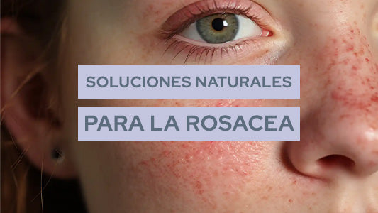 Soluciones naturales para la rosácea